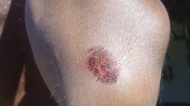 second photo of a severe burn