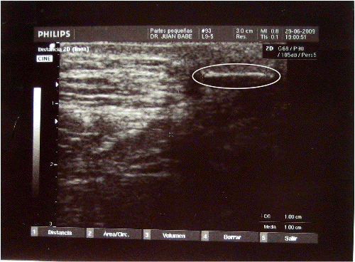 Foreign object - suspected biochip implant with circle.