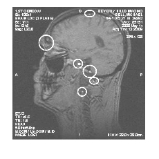 profile with implants circled